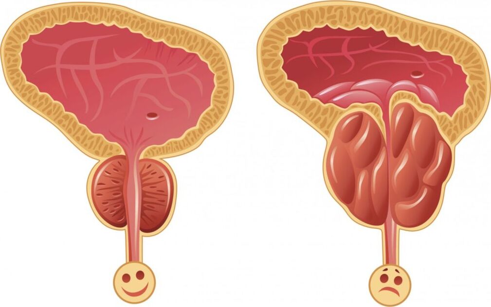 Sintomi di infiammazione della prostata negli uomini